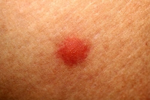 Blutpunkte kleine auf haut rote der Leukozytoklastische Vaskulitis: