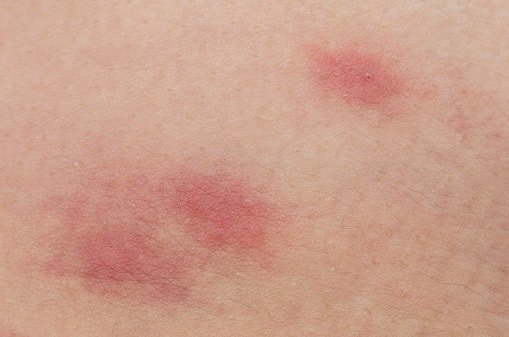 Ausschlag mückenstich ähnlicher Hautausschlag (Ekzem,